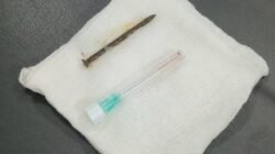 Breaking News: RSUD Arifin Achmad Tangani Kasus Langka Paku 5 Cm Masuk ke Saluran Napas