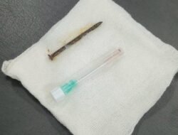 Breaking News: RSUD Arifin Achmad Tangani Kasus Langka Paku 5 Cm Masuk ke Saluran Napas